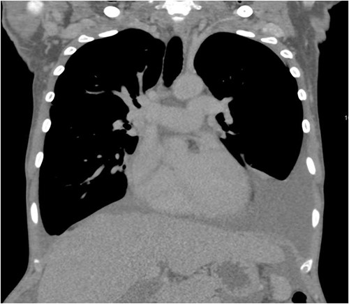 CT scan of the chest shows pleural effusion.