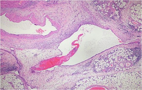 H&E stain of the omentum excision shows multiple, large and irregular disorganized veins and arteries.