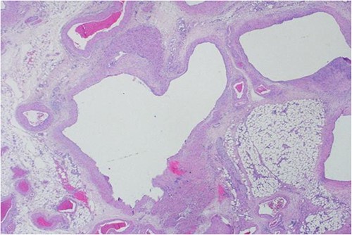 H&E stain of the omentum excision shows multiple, large and irregular disorganized veins and arteries.