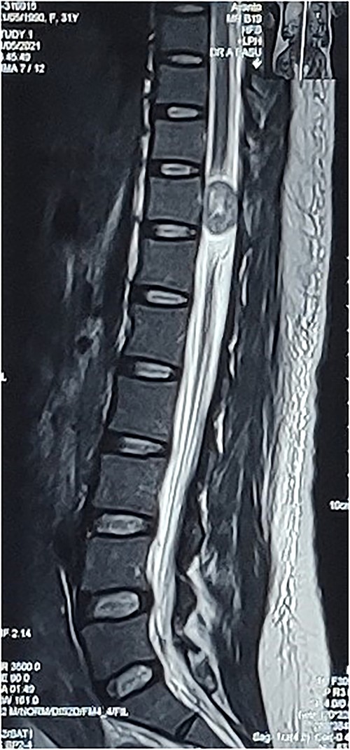 Preop sagittal T2W image showing hyperintense SOL consistent with schwannoma.