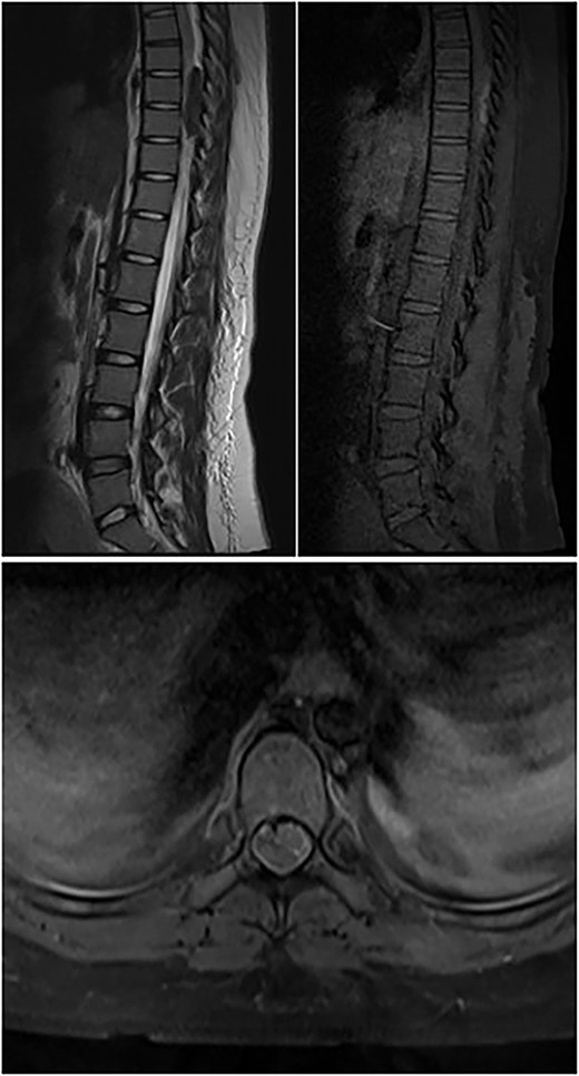 Top left image shows preoperative T2W sagittal MRI of the dorsal spine showing hypointense lesion in the posterior epidural space at D8–9; top right image shows T1W pre-contrast fat-suppressed image showing hyperintensity; bottom image shows post-contrast T1W axial image showing minimal contrast enhancement.