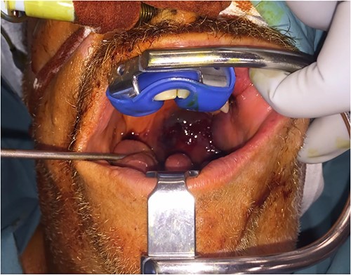 Nasal intubation, with Boyle Davis retractor in situ revealing expansile left palatal haematoma crossing midline.