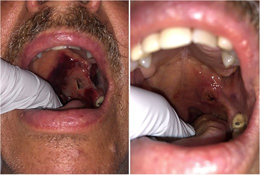 Significant interval improvement at Day 2 post (left) and Day 10 post (right).