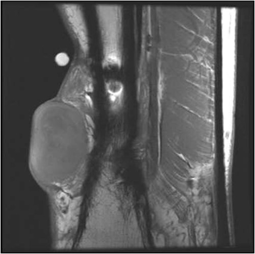 Sagittal T1 MRI, left lower extremity.