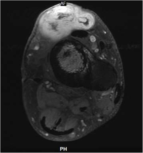 Axial MRI, T1 post FS, left lower extremity.