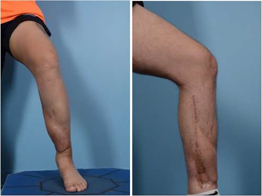 Postoperative photos.