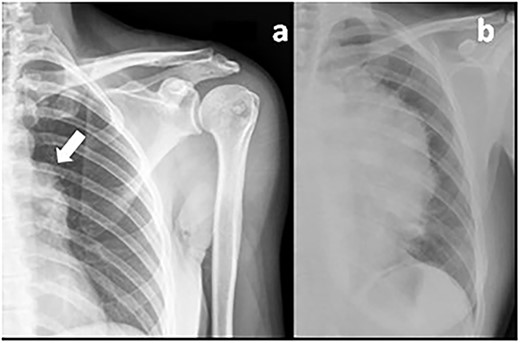 Previous shoulder X-ray (a) showing an irregular shape of the aortic arch (arrow) probably related to the mediastinal mass in comparison with a recent chest X-ray (b) showing the giant thymoma.