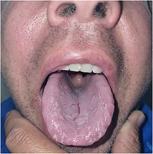 Oral examination revealing an enlarged pendulous uvula with pale mucosa and no midline deviation.
