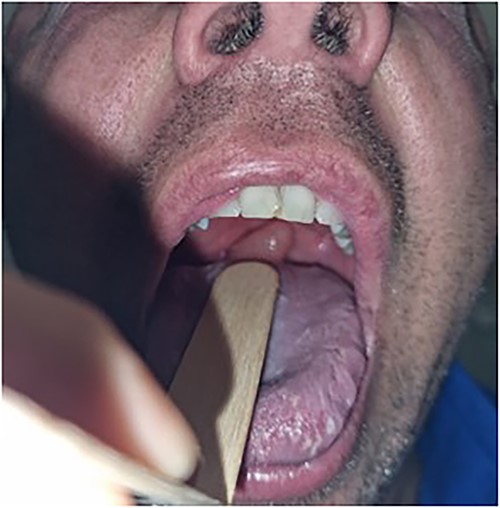 Closer inspection of uvula on oral examination.