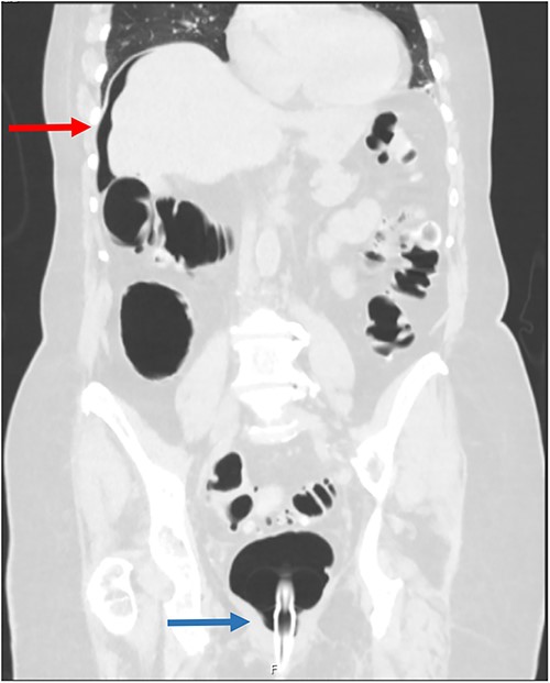 Coronal CT scan following gas insufflation; the red arrow points to pneumoperitoneum above the liver, and the blue arrow points to a rectal catheter.