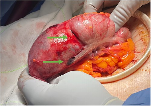Clinical photograph of the caecum following laparoscopy; the green arrows point to a large tear in caecum and a tear overlying the taenia coli.