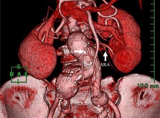 Preoperative CT angiography revealed that the IMA and ARA branched closely from the sac.