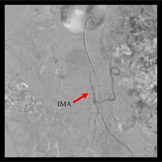 Angiography 8 years after EVAR demonstrated a type II endoleak from the IMA.