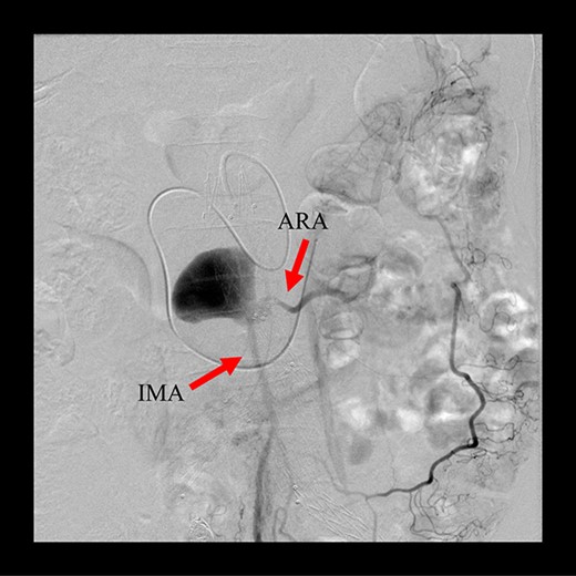 Sac angiography from the IMA via Riolan’s arcade showed a flow-through endoleak to the ARA as a drainage artery.