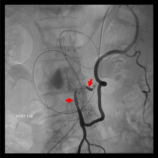 Coil embolization of the IMA and ARA was performed successfully via Riolan’s arcade.