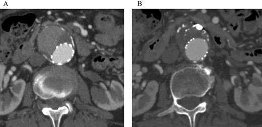 Post-embolization CT demonstrated that the sac shrank with no evidence of a continuing endoleak. (A) Pre-embolization CT showed a contrast effect in the sac. (B) Post-embolization CT showed no contrast effect in the sac.