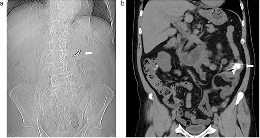 The image data were obtained by the previous doctor; (a) X-ray examination: the arrow shows the swallowed denture; (b) the coronal image of the CT: the arrow shows the swallowed denture.