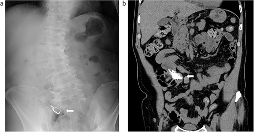 The image data were obtained at our hospital; (a) X-ray examination: the arrow shows the swallowed denture; (b) the coronal image of the CT: the arrow shows the swallowed denture.