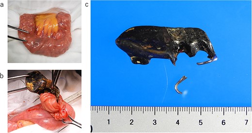 Intraoperative photograph and image of the removed denture; (a) the small intestine removed outside the body: there were no abnormal findings on the serosal surface; (b) a denture found in the small intestine: the hook part involved the small intestinal mucosa; (c) removed denture: the hook part is damaged during extraction.
