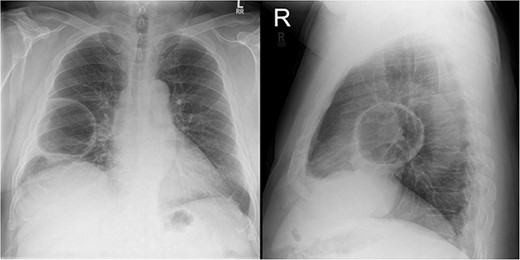 Initial chest X-ray on presentation.