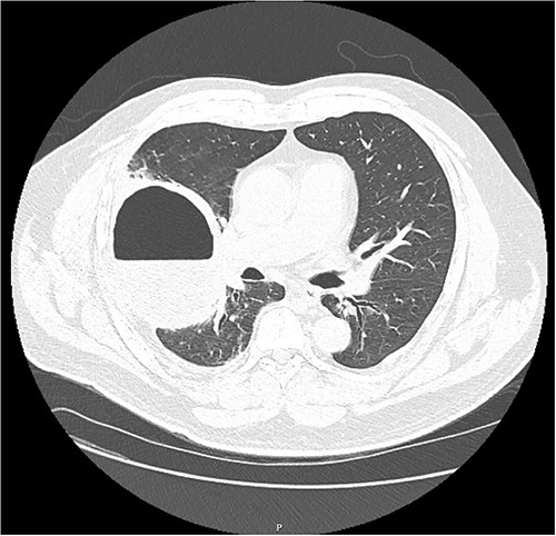 Lung lesion on high-resolution CT.
