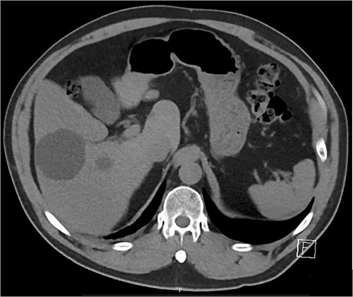 Liver lesions on CT abdomen pelvis in the portal venous phase.