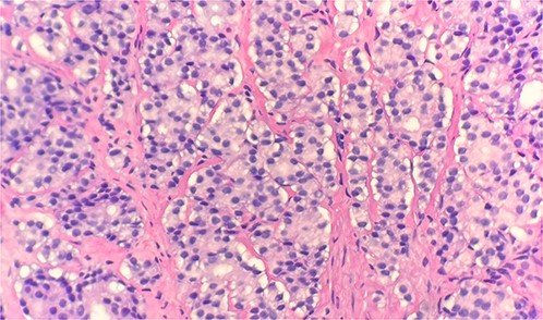 Microscopic examination reveals sheets of tumor cells with invasive growth pattern (H&E stain 40×).