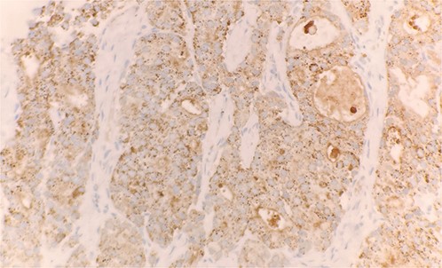 Tumor cells expressed PSAP on immunohistochemical stain (IHC stain 40×).