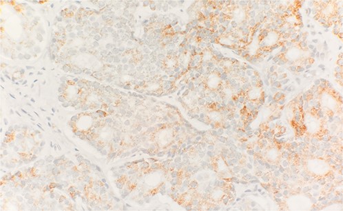 Tumor cells are positive for Alpha methyacyl CoA racemase (p504s) (IHC stain 40×).