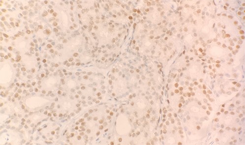 Tumor cells expressed CDX2 on immunohistochemical stain (IHC stain 40×).