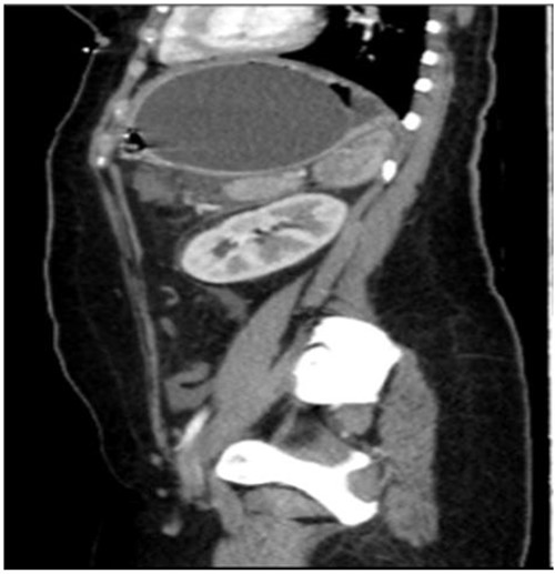 Axial computed tomography (CT) showing IGB compressing the pancreatic body with mild pancreatic edema, regional fat stranding and surrounding fluid collection seen tracking to left perirenal space.