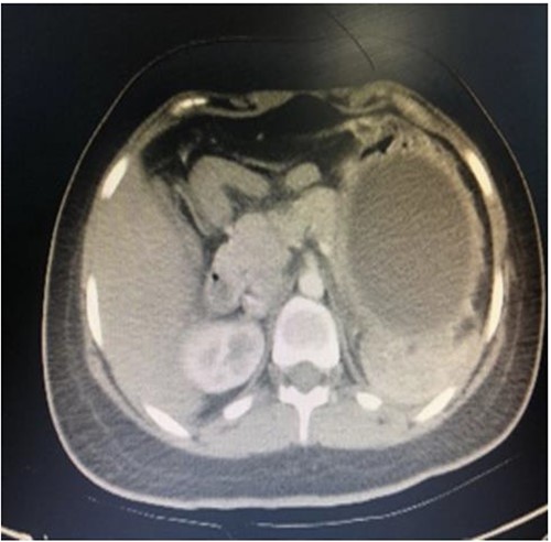Coronal CT showing the position of the IGB.