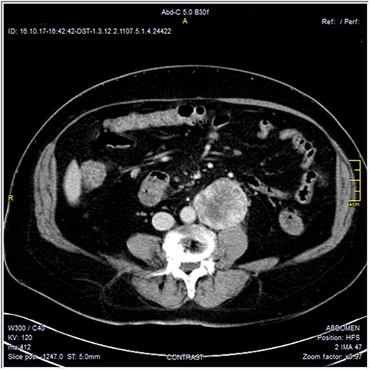 Contrast-enhanced axial CT images—soft tissue window, show well-defined peripherally enhancing mass lesion at left para-aortic region. No local invasion.
