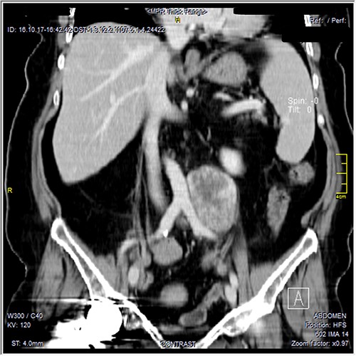 Contrast-enhanced reformatted coronal images—soft tissue window, show well-defined peripherally enhancing mass lesion seen along the left lateral wall of distal aorta and left common iliac artery. Preserved fat planes between the lesion and adjacent aorta and common iliac can be well appreciated with no signs of local invasion. A metal artifact from right hip prostheses is noted.