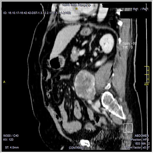 Contrast-enhanced reformatted sagittal images—soft tissue window, show well-defined peripherally enhancing lobular mass lesion. Preserved fat planes around the lesion are noted with no signs of local invasion.
