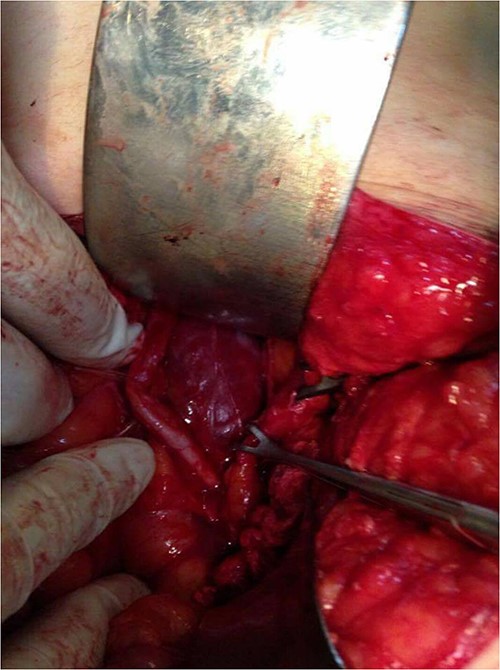 Intraoperative photo, showing the mass and ureter.