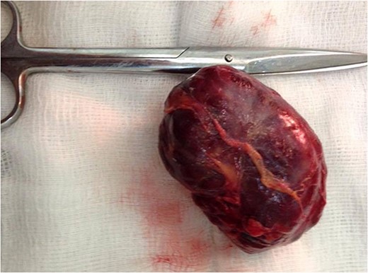 Postoperative photo shows well-defined lobulated dark mass.