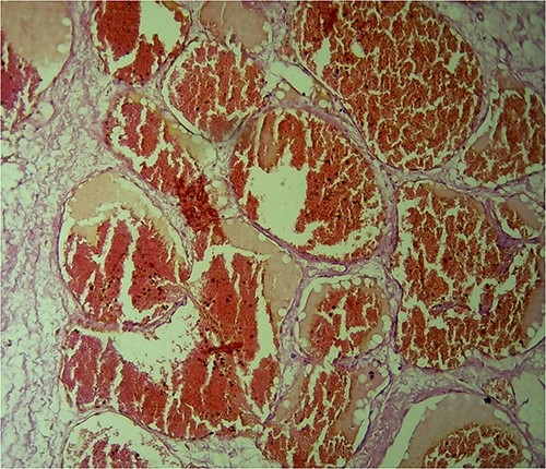 H&E-stained histological sections show hugely ectatic variable sizes vascular spaces lined by flattened endothelial cells filled with blood, separated by fibrous tissue and extending between the fatty tissues. Magnification power: ×40. Diagnosis: cavernous hemangioma.