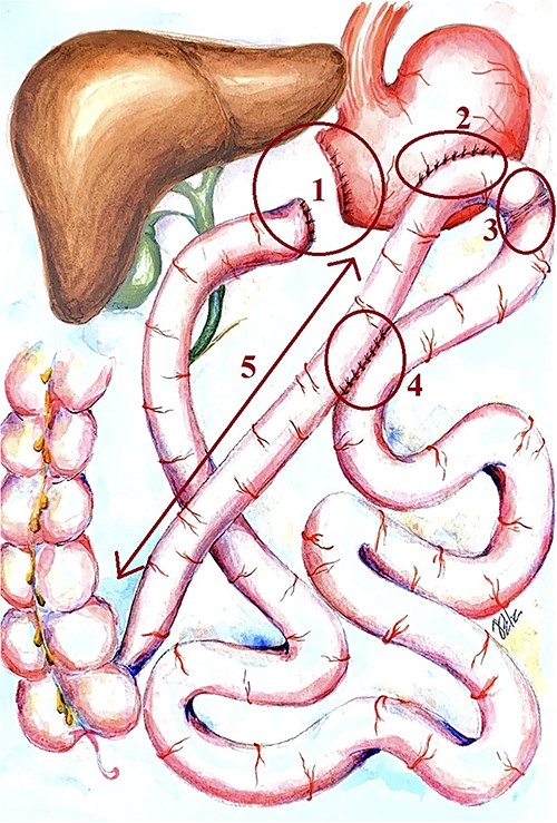 Scheme of the primary bariatric surgery. 1: gastric stump and duodenic stump, 2: gastroenteroanastomosis bypass, 3: Shalimov’s plug (staple line on proximal intestine), 4: Braun anastomosis and 5: 1 m length ileal loop between the gastroenteroanastomosis and the ileocecal angle.
