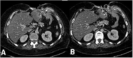 CT scan of the abdomen, axial view, venous phase. (А) Vast defect of the abdominal wall, distal gastric stump and (B) gastroenteroanastomosis leakage. Fistula opening in the wound in the left subcostal area.