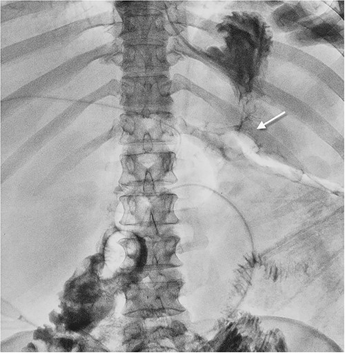 Fistulogram showing gastroenteroanastomosis leakage. The contrast spilling from the gastroenteroanastomosis to the abdominal wall wound.