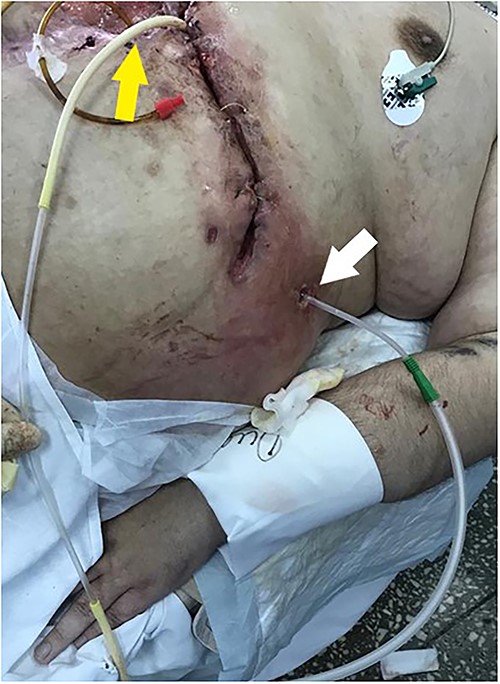 The subcutaneous wound is closed, drainage for the active aspiration is set in the fistula region. The Foley tube for the “fistuloclysis” is intubated into the efferent bowel loop.