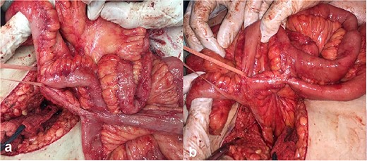 Intraoperative photos: (a) enteroenteroanastomosis in the medium part of the small bowel and (b) two enteroenteroanastomosis 5 cm apart the ileocecal angle.