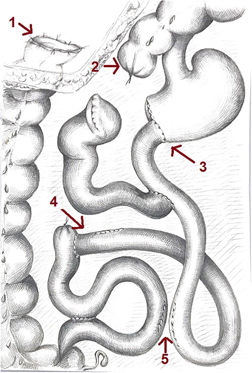 Scheme of the gastrointestinal tract after the reconstructive surgery: 1—colostomy, 2—distal stump of the transverse colon closed, 3—end-to-end gastrojejunoanastomosis, 4—resected enteroenteroanastomosis with the part of the bowel and 5—resected enteroenteroanasthomosis.