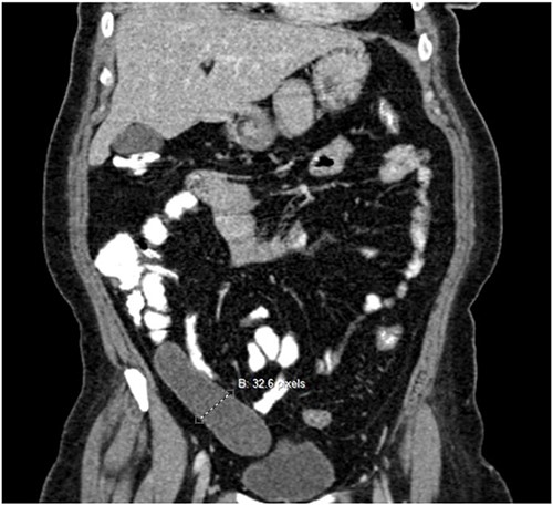 Pre-operative Computed tomography scan showing appendix mucocele.
