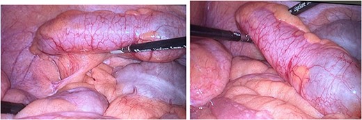Operative photograph showing large mucinous cystadenoma of the appendix.