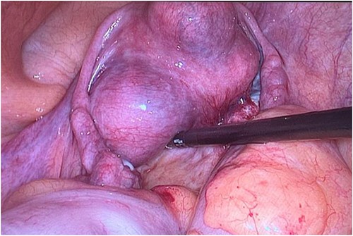 Operative photograph showing the uterine fibroid.