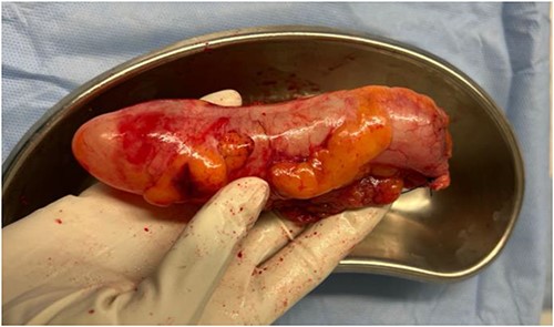 Post-operative photograph of the tumor.