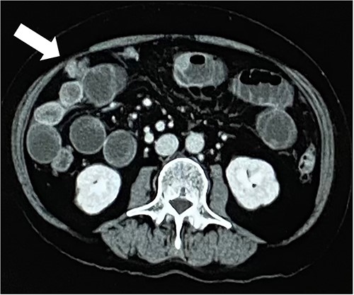 White arrow indicates peritoneal nodule.