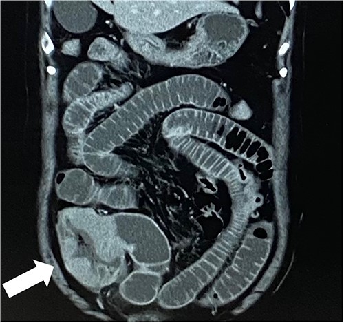 White arrow points to mass lesion in the cecum.